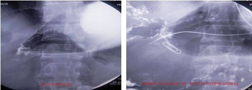 我院介入放射科成功完成一例残胃癌支架植入术